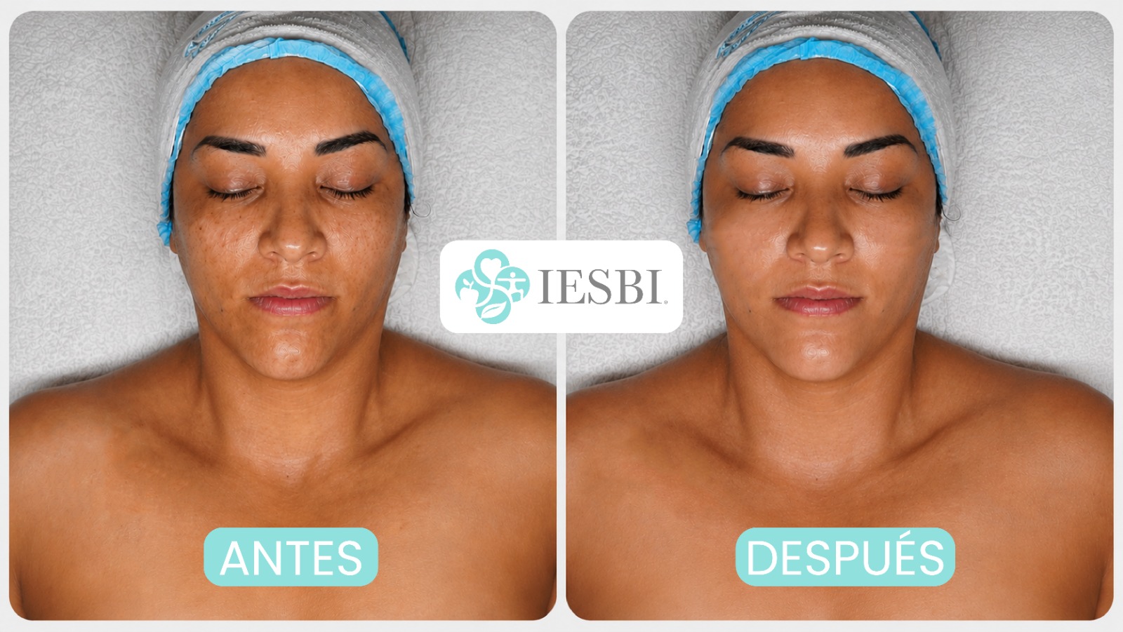 Resultados antes y después - Peeling Químico Integral IESBI
